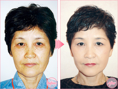 フェイスリフト