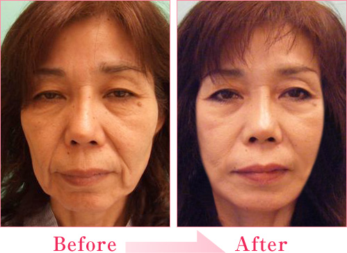 フェイスリフト