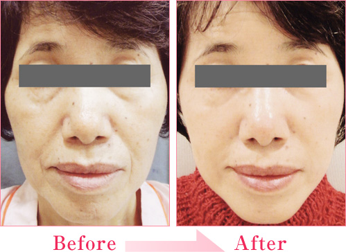 フェイスリフト