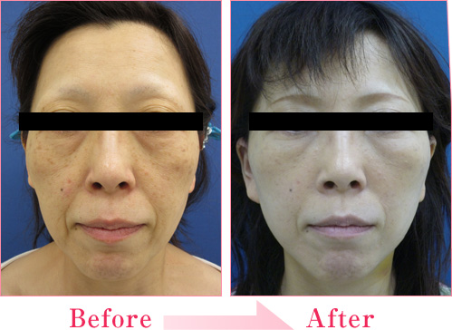 フェイスリフト