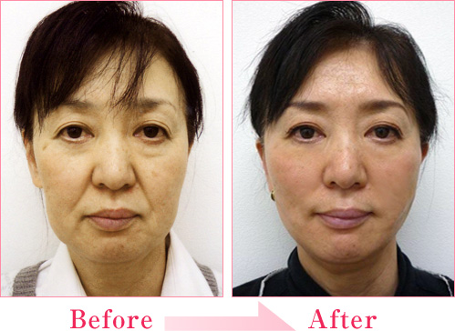 ミラクルリフト