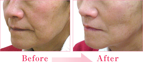 ミラクルリフト