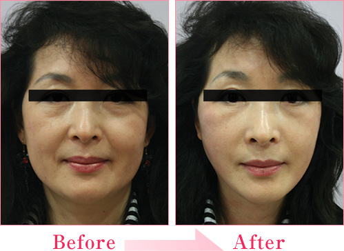 ミラクルリフト