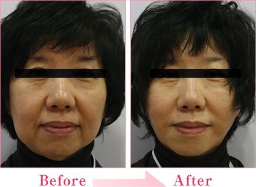 ミラクルリフト