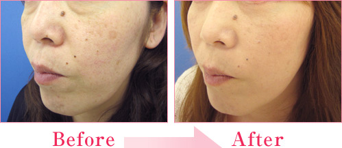 ミラクルリフト