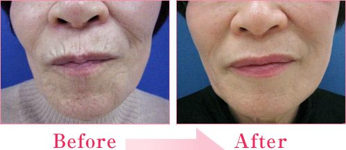 ミラクルリフト