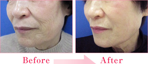 ミラクルリフト