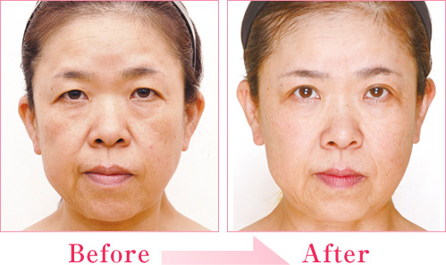 ミラクルリフト