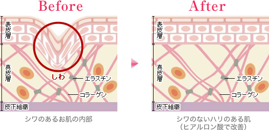Before(シワがあるお肌の内部)→After(シワのないハリのある肌【ヒアルロン酸で改善】)