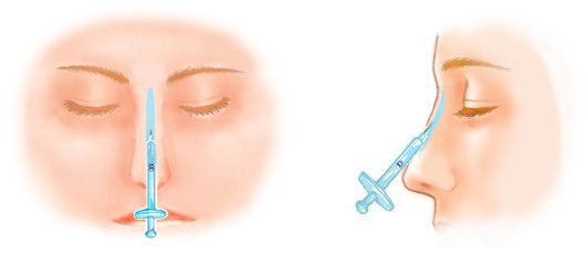 隆鼻術(ヒアルロン酸注入)